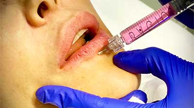 Filler labbra